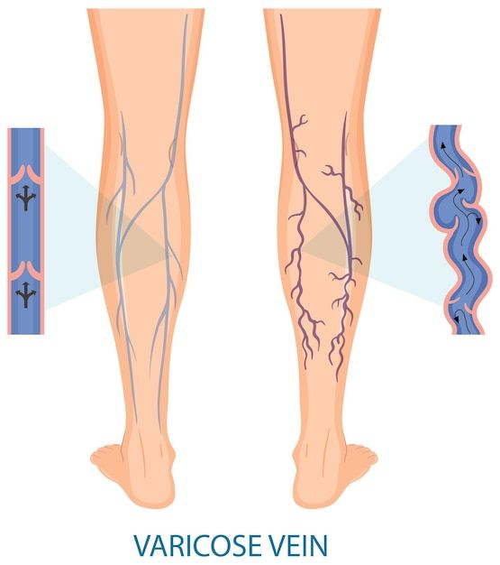 VARICOSE VEINS MEDICATIONS