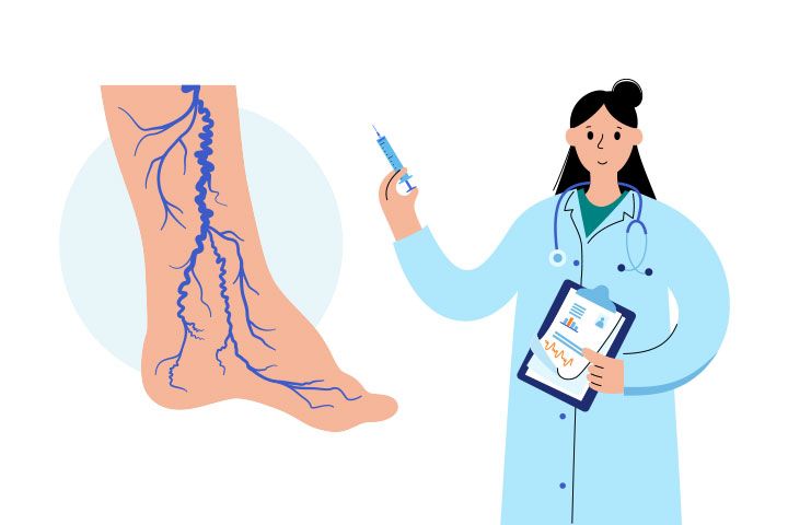 VARICOSE VEINS INJECTIONS